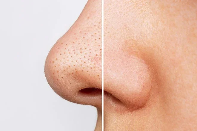 How to Get Rid of Blackheads Using a Blackhead Remover Tool