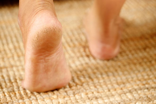 How to get Rid of Calluses and Corns: Treatment and Prevention
